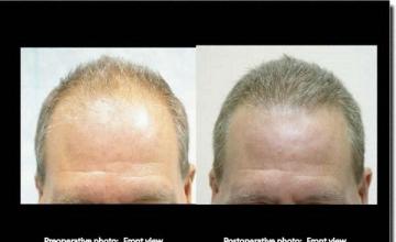 Hair restoration procedure results