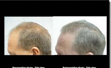 Hair restoration procedure results