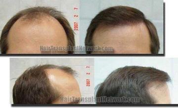 Hair restoration procedure results