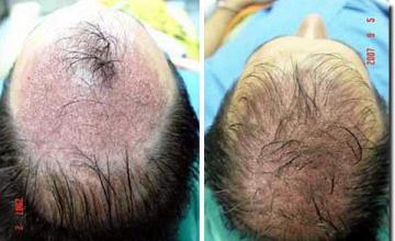 Hair restoration procedure results