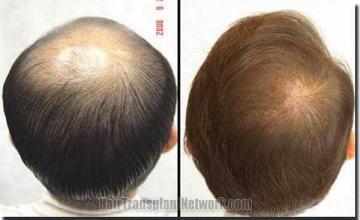 Hair restoration procedure results