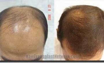 Hair restoration procedure results