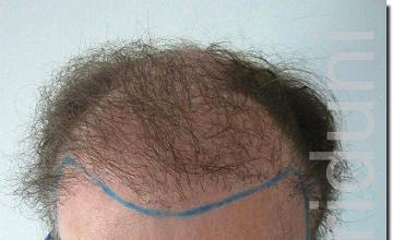 Hair restoration procedure results