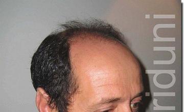 Hair restoration procedure results