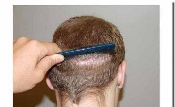 Hair restoration procedure results