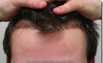 Hair restoration procedure results