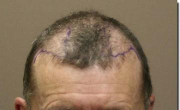 Hair restoration procedure results