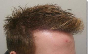 Hair restoration procedure results