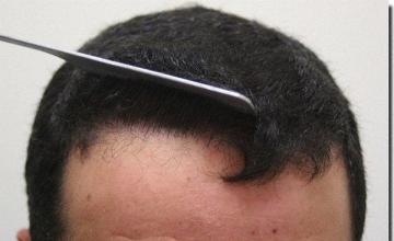 Hair restoration procedure results