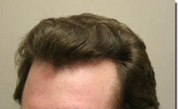 Hair restoration procedure results