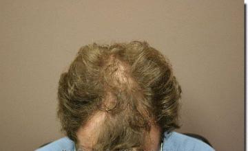 Hair restoration procedure results