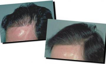 Hair restoration procedure results