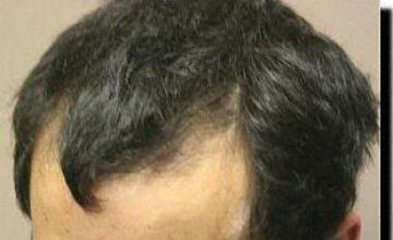 Hair restoration procedure results