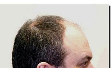 Hair restoration procedure results