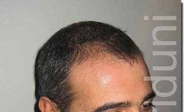 Hair restoration procedure results