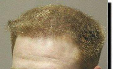 Hair restoration procedure results