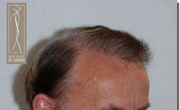 Hair restoration procedure results