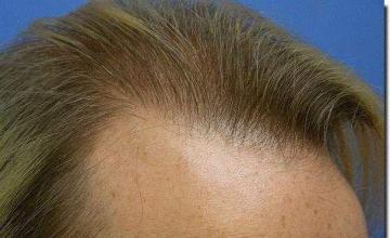 Hair restoration procedure results