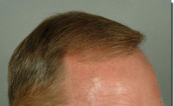 Hair restoration procedure results