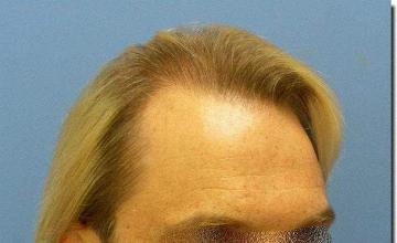 Hair restoration procedure results