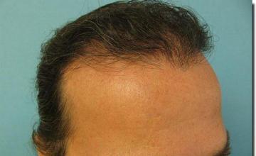 Hair restoration procedure results