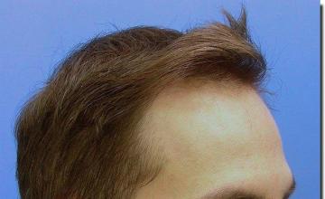 Hair restoration procedure results