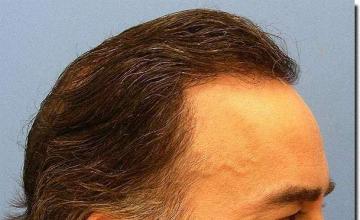 Hair restoration procedure results