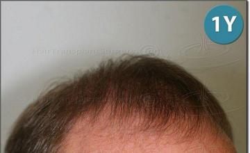 Hair restoration procedure results