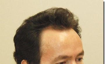 Hair restoration procedure results