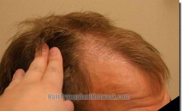 Hair restoration procedure results