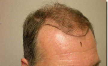 Hair restoration procedure results