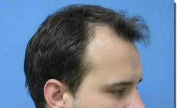 Hair restoration procedure results