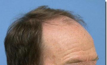 Hair restoration procedure results