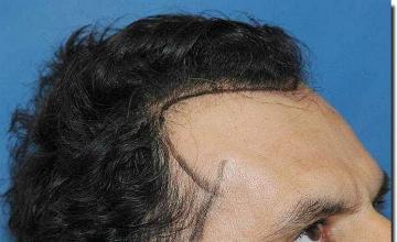 Hair restoration procedure results