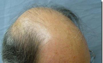 Hair restoration procedure results