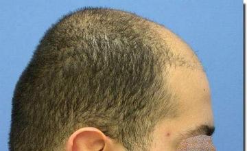 Hair restoration procedure results