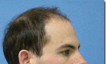 Hair restoration procedure results