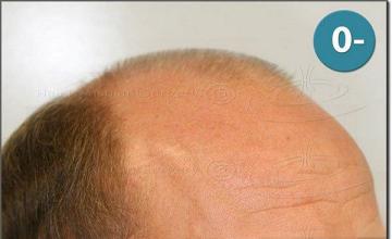 Hair restoration procedure results