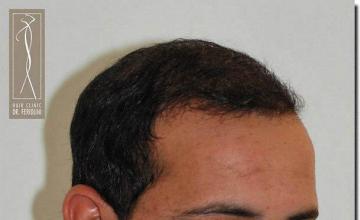 Hair restoration procedure results