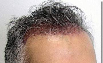 Hair restoration procedure results