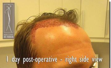 Hair restoration procedure results