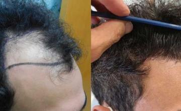 Right of patient, before and results of hair transplant