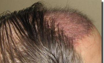 Hair restoration procedure results