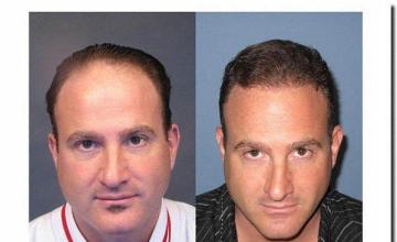 Hair restoration procedure results