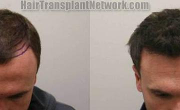 Hair restoration procedure before and after pictures