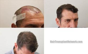 Hair transplantation surgery before and after photos