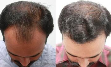 Before and after images hair transplant procedure