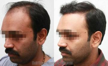 Left view before and after hair restoration procedure