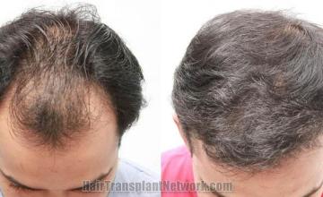 Hair transplantation procedure result photos