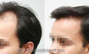 Left view  - Before and after surgical hair replacement